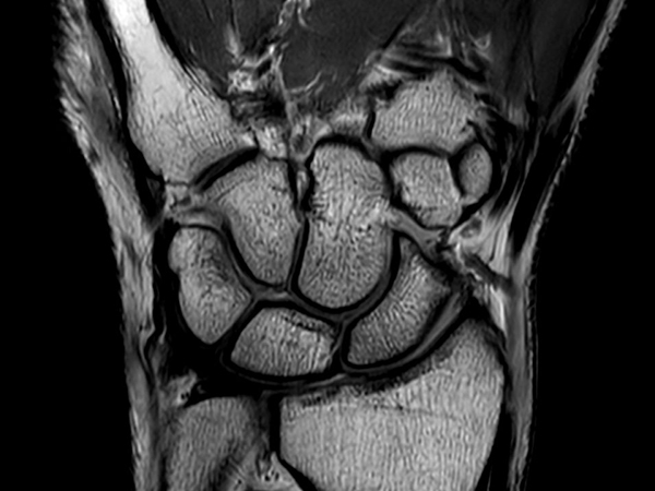 Coronal PDw TSE