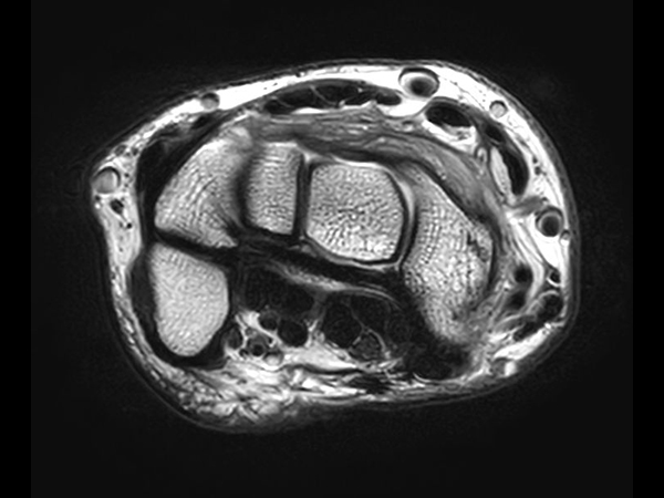 Axial T2w TSE