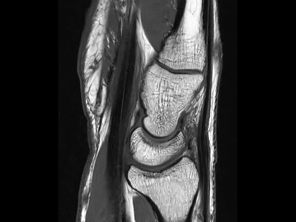 Sagittal T1w TSE<b>SmartSpeed Resolution</b>