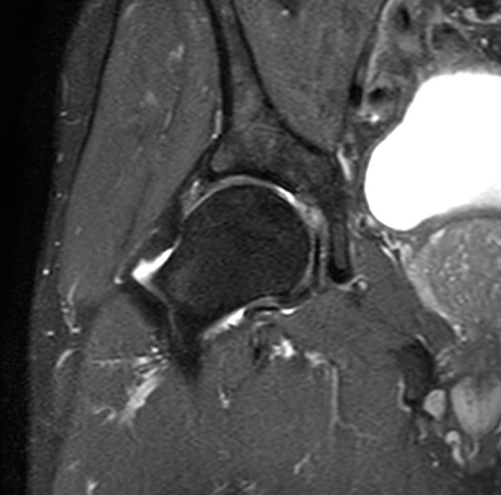 Coronal PDw TSE FatSat<b>SmartSpeed</b>