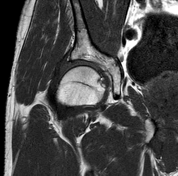 Coronal T1w TSE<b>SmartSpeed</b>
