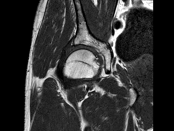 Coronal T1w TSE<b>SmartSpeed Resolution</b>