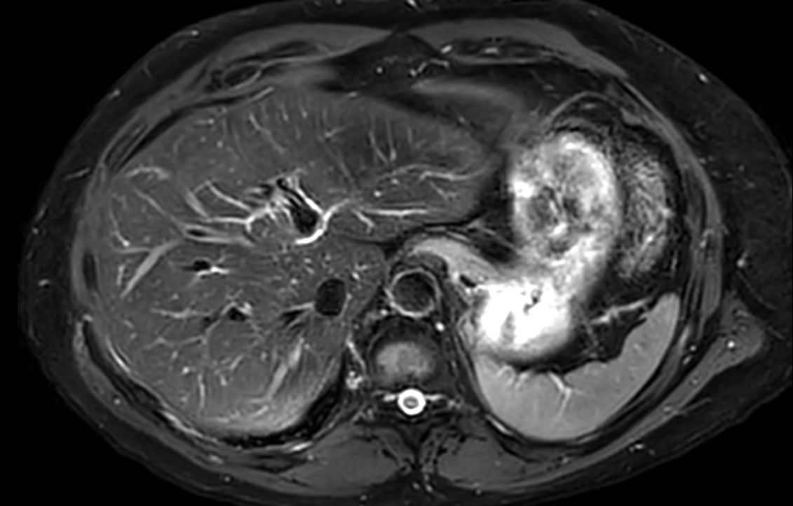 Axial T2w TSE mDIXON (water only)<b>SmartSpeed MotionFree</b>