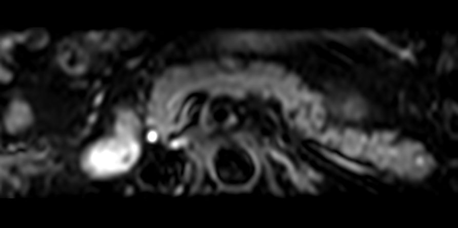 Axial DWI IRIS Zoom (b0)