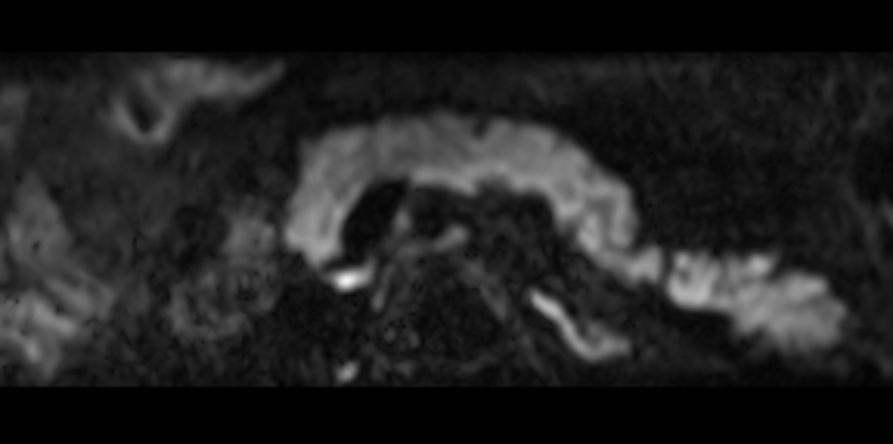 Axial DWI IRIS Zoom (b800)