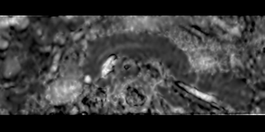 Axial DWI IRIS Zoom (ADC)