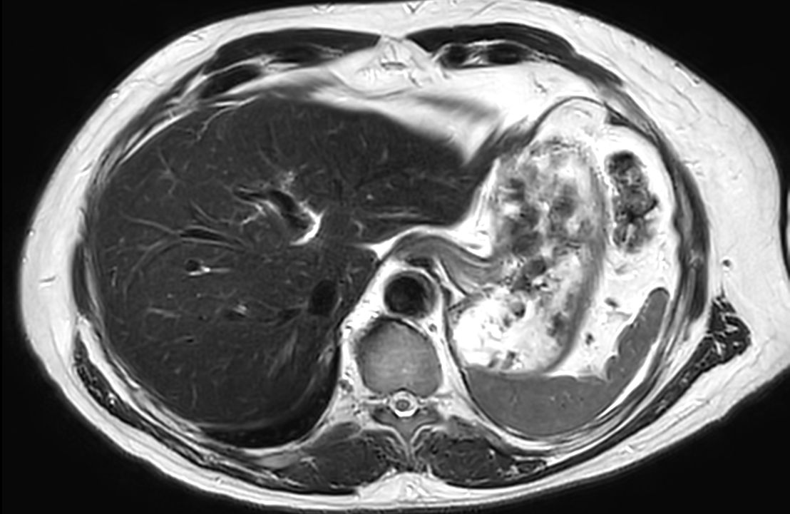 Axial T2w TSE<b>SmartSpeed Motion-Free</b>