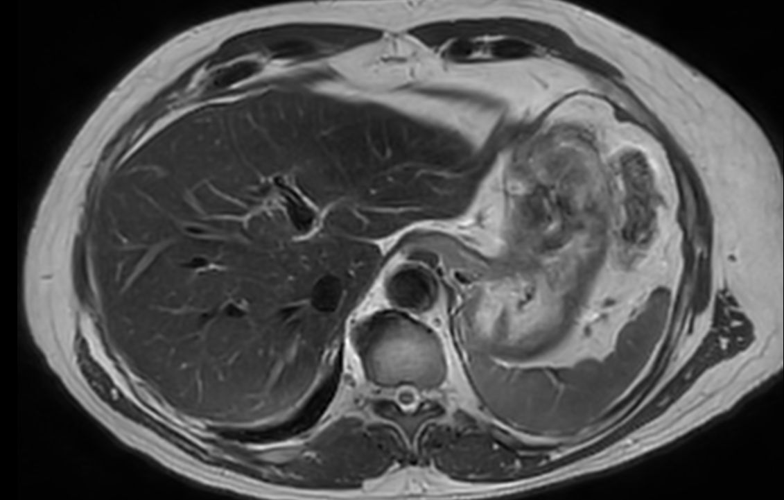 Axial T2w TSE mDIXON (in-phase)<b>SmartSpeed MotionFree</b>