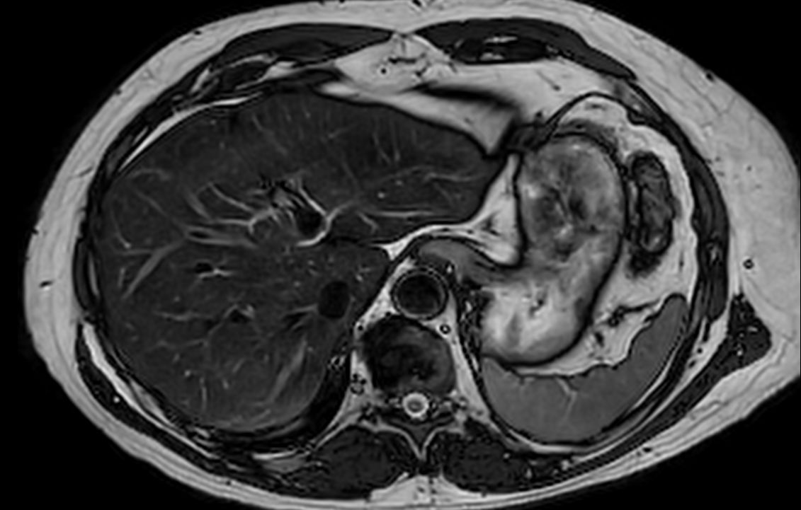 Axial T2w TSE mDIXON (out-phase)<b>SmartSpeed Diffusion</b>