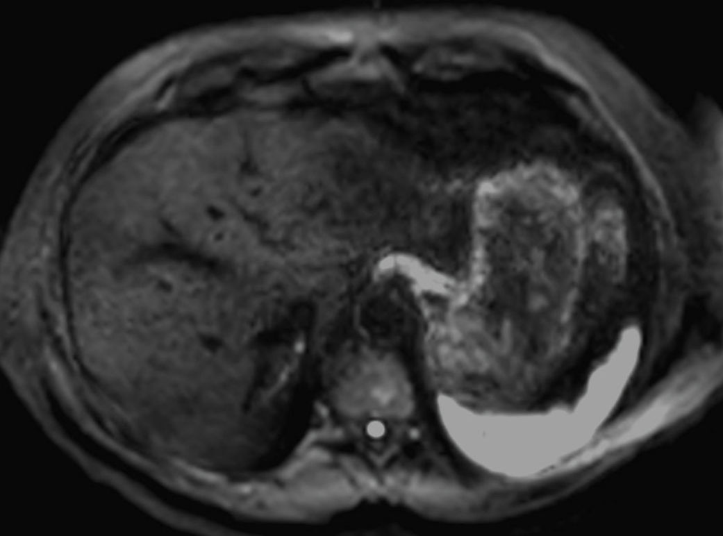 Axial DWI (b1000)<b>SmartSpeed Diffusion</b>