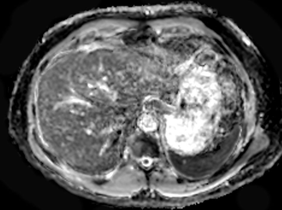Axial DWI (ADC)<b>SmartSpeed Diffusion</b>