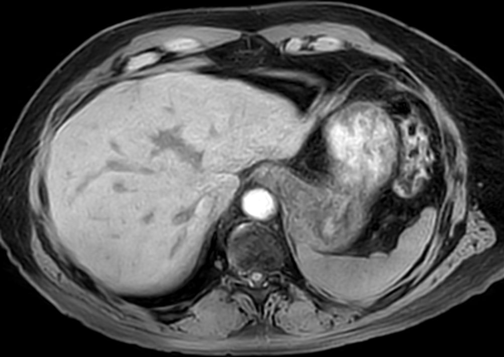 Axial T1w 3D VANE XD (water only)<b>SmartSpeed 3D FreeBreathing</b>