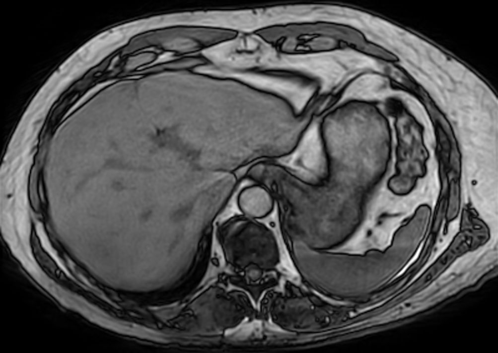 Axial T1w 3D VANE XD (out-phase)<b>SmartSpeed 3D FreeBreathing</b></b>