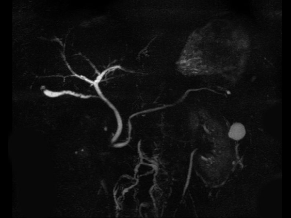 Coronal 3D MRCP<b>SmartSpeed</b>