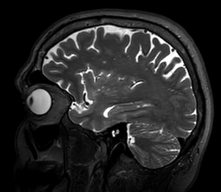 Sagittal 3D VIEW - T2w TSE