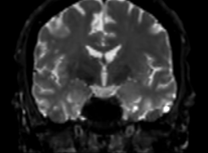 DWI b1000 (coronal reformat)