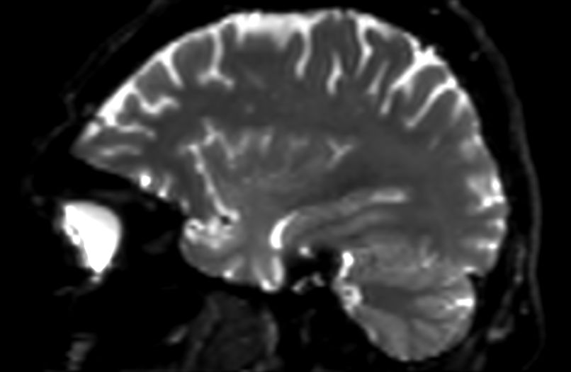DWI b1000 (sagittal reformat)