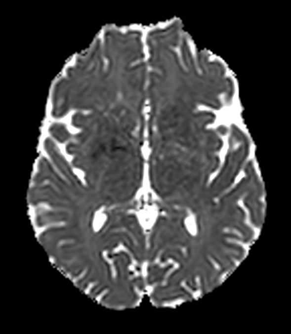 Axial DWI b1000 (ADC)