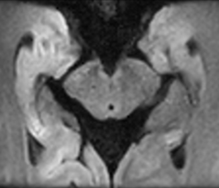 Axial IRIS Zoom b1000