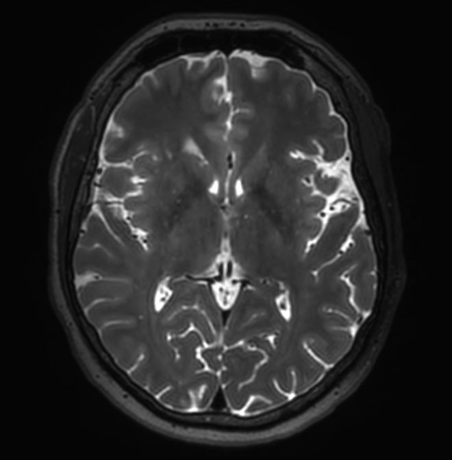 3D VIEW - T2w TSE (axial reformat)