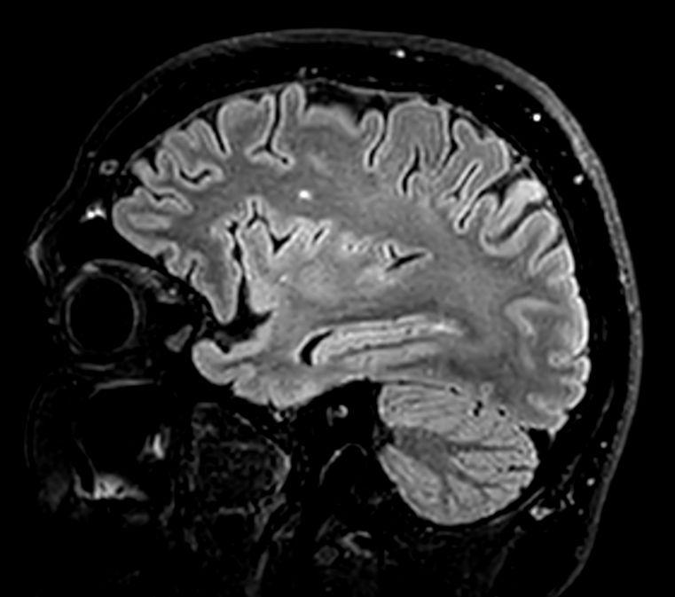 Sagittal 3D VIEW - T2w FLAIR