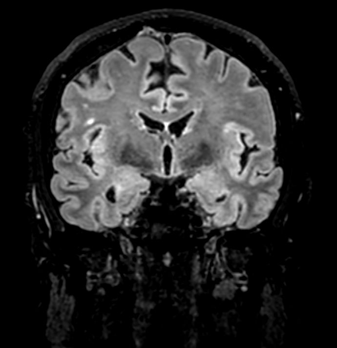 3D VIEW - T2w FLAIR (coronal reformat)