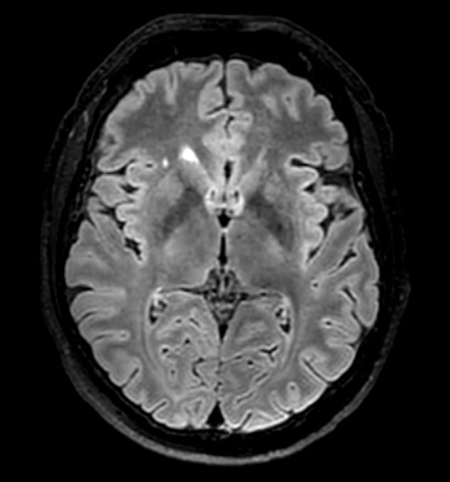 3D VIEW - T2w FLAIR (axial reformat)