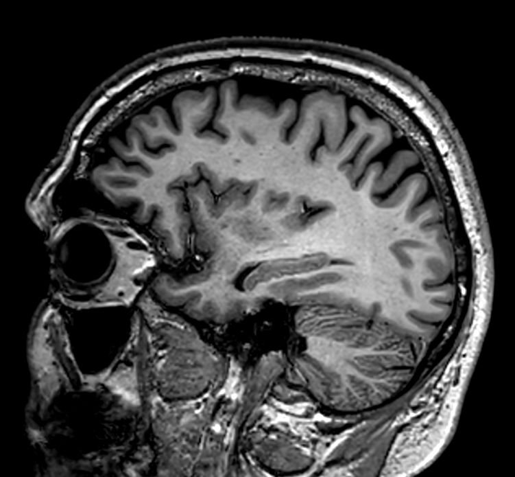 Sagittal 3D VIEW - T1w TSE