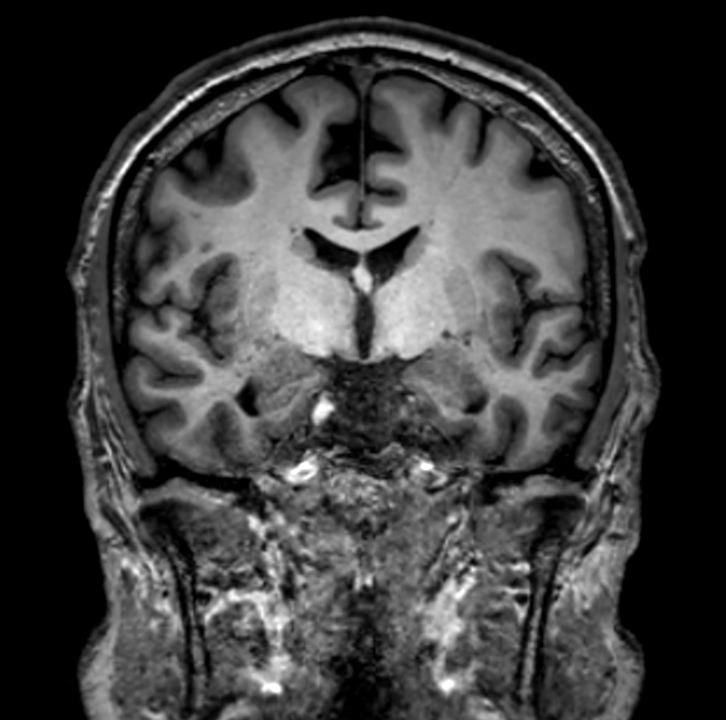 3D VIEW - T1w TSE (coronal reformat)