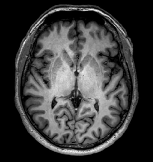 3D VIEW - T1w TSE (axial reformat)