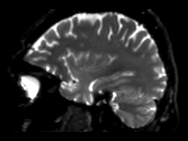 DWI b1000 (sagittal reformat)