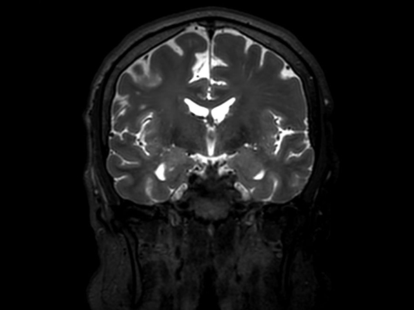 3D VIEW - T2w TSE (coronal reformat)