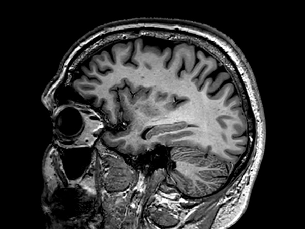 Sagittal 3D VIEW - T1w TSE