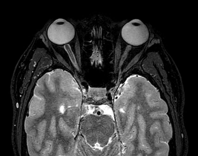 Axial 3D VIEW - T2w FatSat