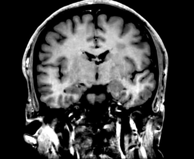 3D VIEW - T1w TSE (coronal reformat)<p>Post-Gado