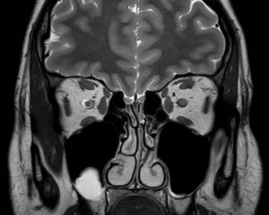 Coronal T2w TSE mDIXON (In-Phase)