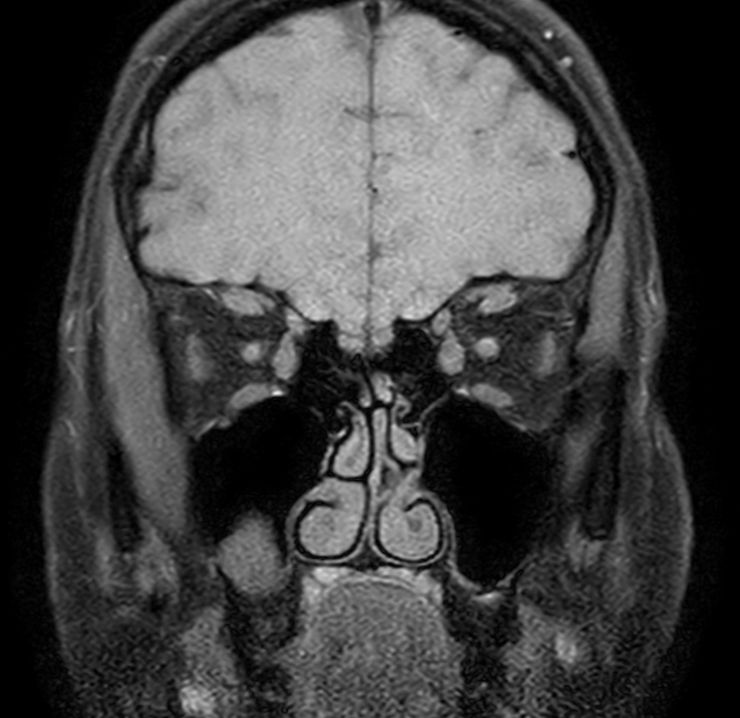 Coronal T1w TSE mDIXON (Water only)<p>Pre-Gado