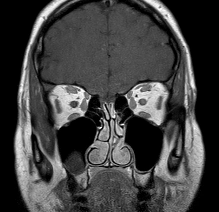 Coronal T1w TSE mDIXON (In Phase)<p>Post-Gado