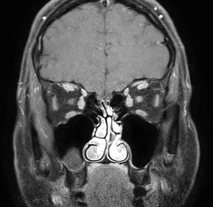 Coronal T1w TSE mDIXON (Water only)<p>Post-Gado
