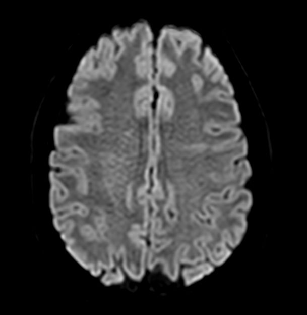 Axial Diffusion (b1000)