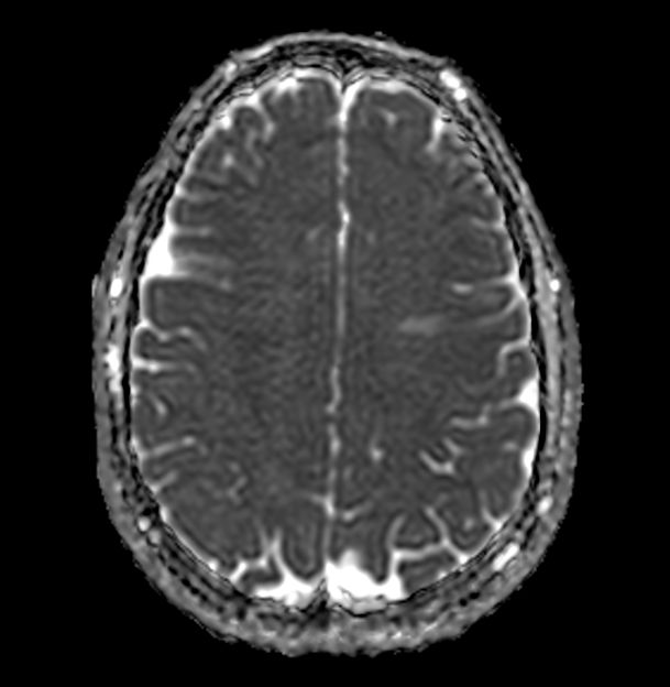 Axial Diffusion (ADC)
