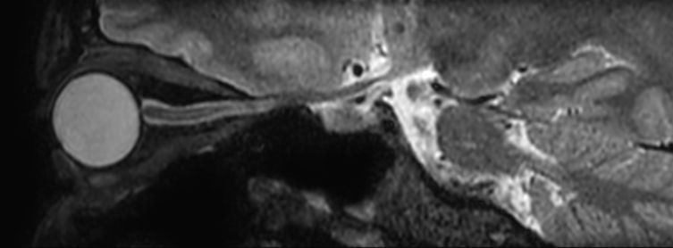 3D VIEW - T2w FatSat (sagittal reformat)