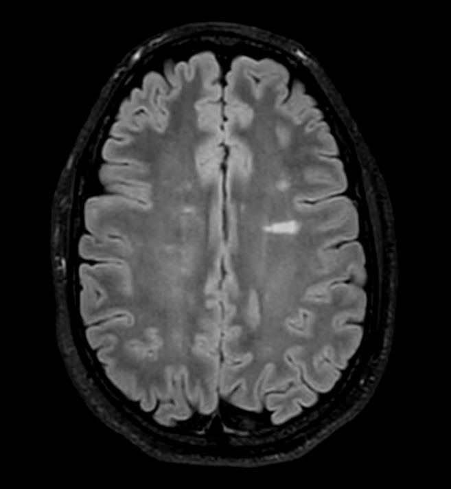 Axial 3D VIEW - T2w FLAIR