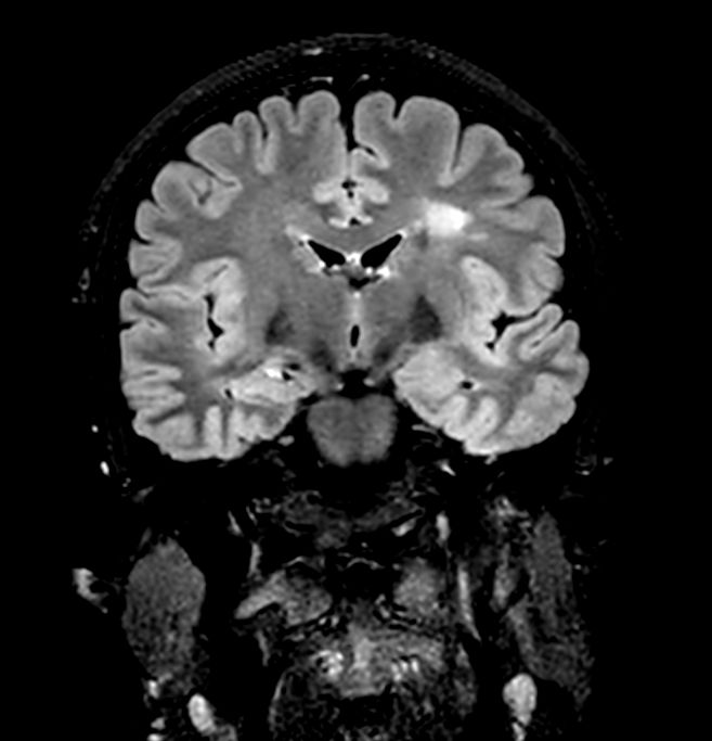 3D VIEW - T2w FLAIR (coronal reformat)