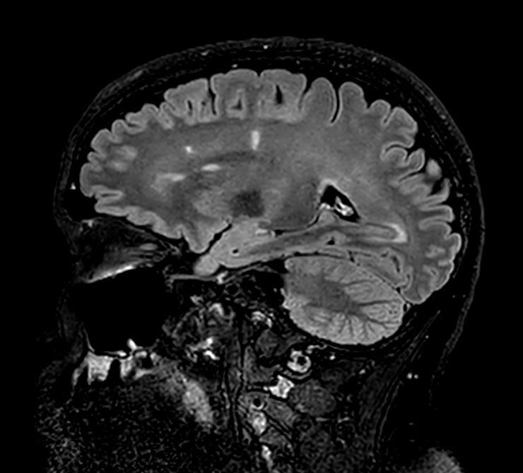 3D VIEW - T2w FLAIR (sagittal reformat)