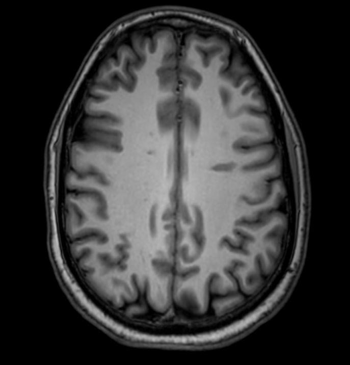 3D VIEW - T1w TSE (axial reformat)<p>Pre-Gado