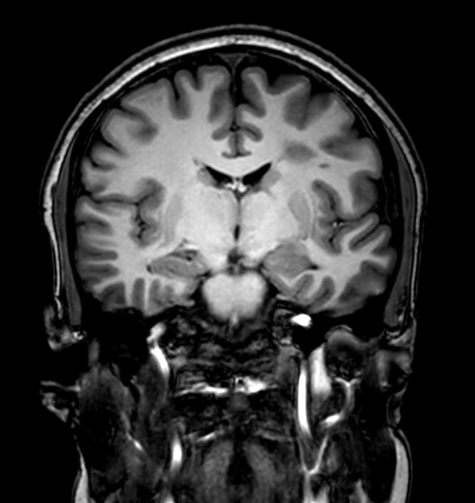 3D VIEW - T1w TSE (coronal reformat)<p>Pre-Gado