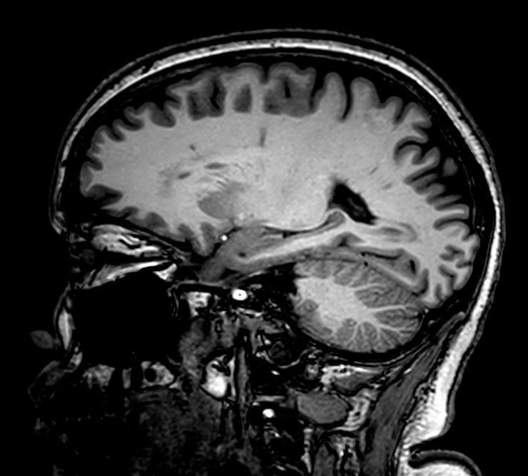 Sagittal 3D VIEW - T1w TSE<p>Pre-Gado
