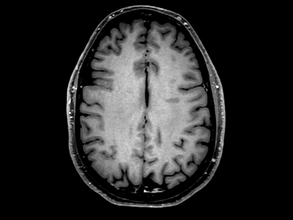 Axial 3D VIEW - T1w TSE<p>Post-Gado