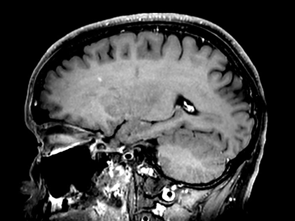 3D VIEW - T1w TSE (sagittal reformat)<p>Post-Gado